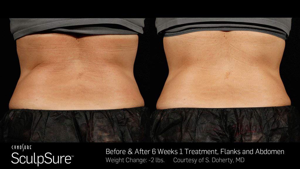 Permanent Cosmetic — Women Body Before and After in Wellington, FL