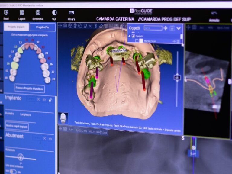 Schermata CAD/CAM dentale che mostra una scansione 3D della mandibola con marcatori colorati e strumenti di pianificazione implantare.