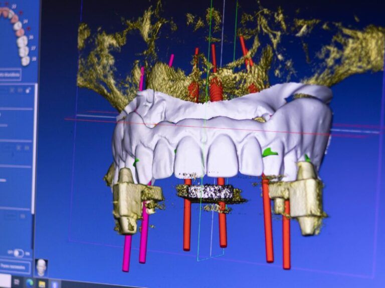 Modello 3D per la pianificazione di impianti dentali con denti bianchi, marcatori rossi e guide implantari dorate su uno schermo blu.