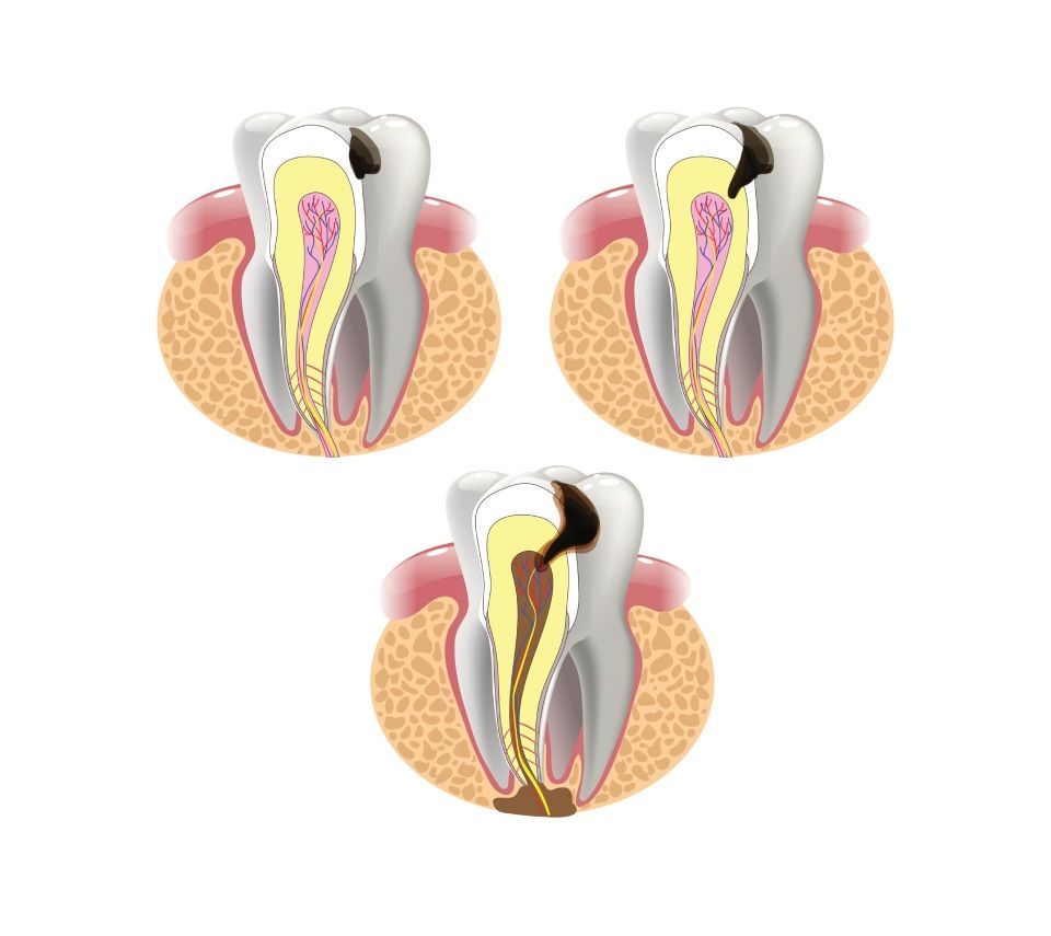 Grafica di un dente cariato