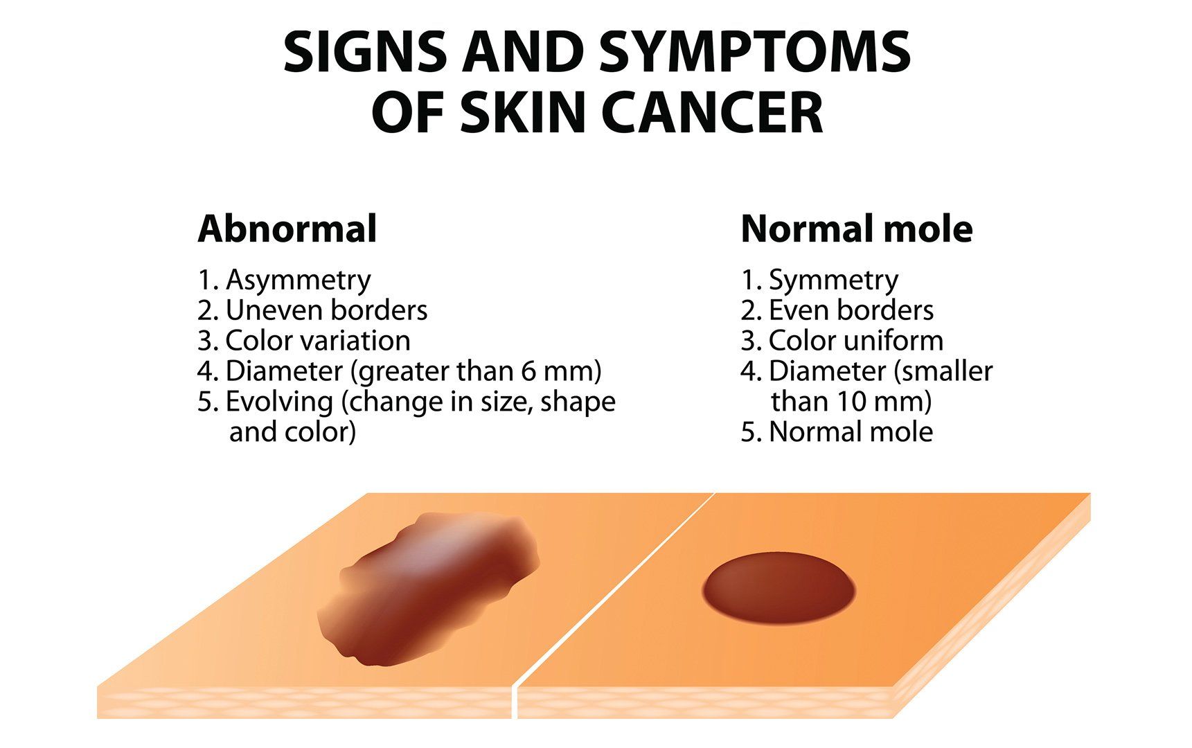 Sign And Symptoms Of Skin Cancer — Voorhees, NJ — Bennett K. Schwartz, M.D.