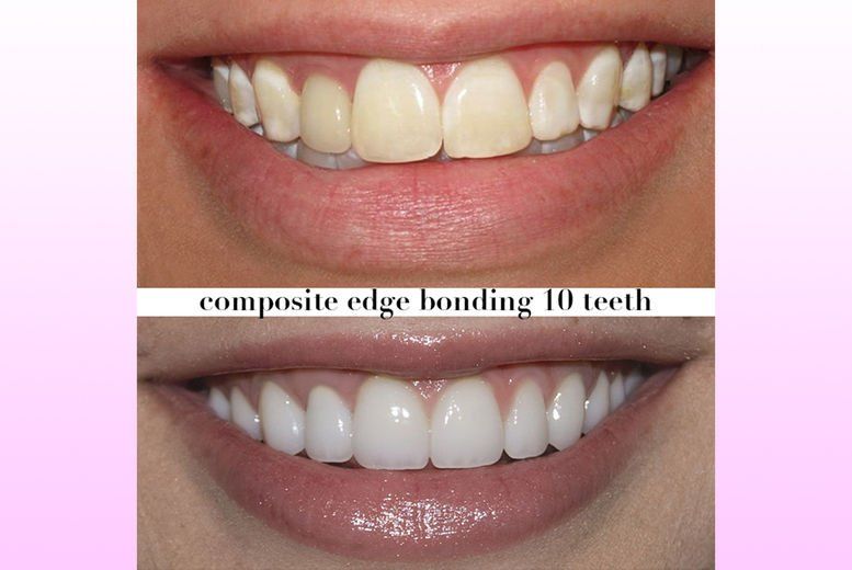 Direct Composite Bonding