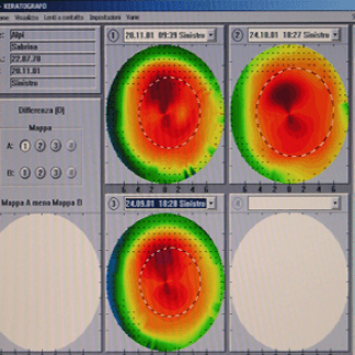 Esempio di topografia corneale