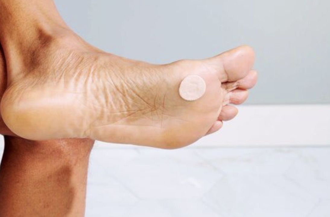 Best Treatment for Plantar Warts | Which Option Is Right for You?