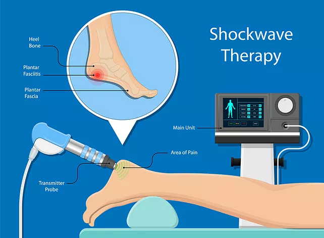 Shockwave therapy diagram showing podiatry treatment for heel pain at Newcastle Podiatrist Clinic