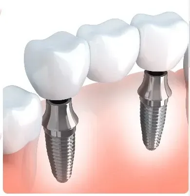 implante com carga imediata