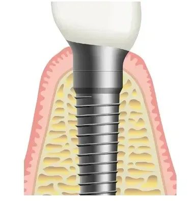 implante com enxerto osseo