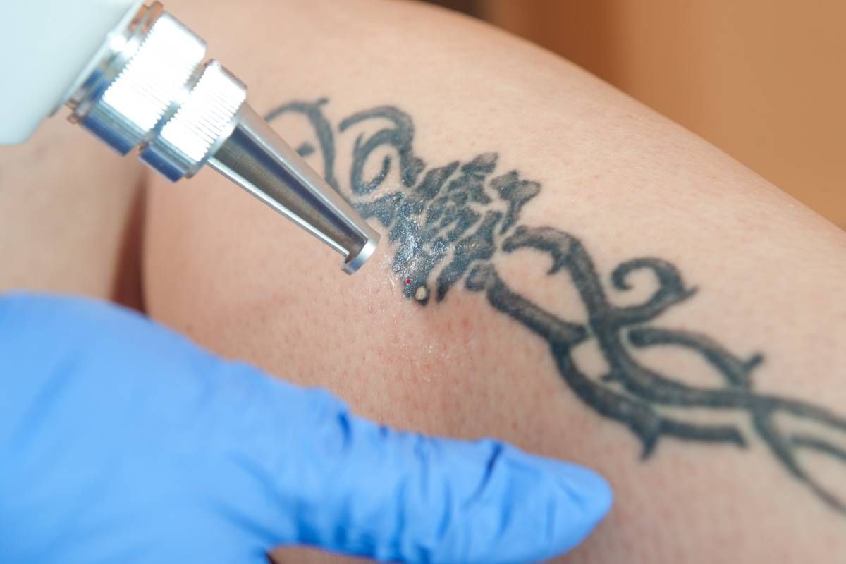 A laser tattoo removal sessions near Lexington, Kentucky (KY)