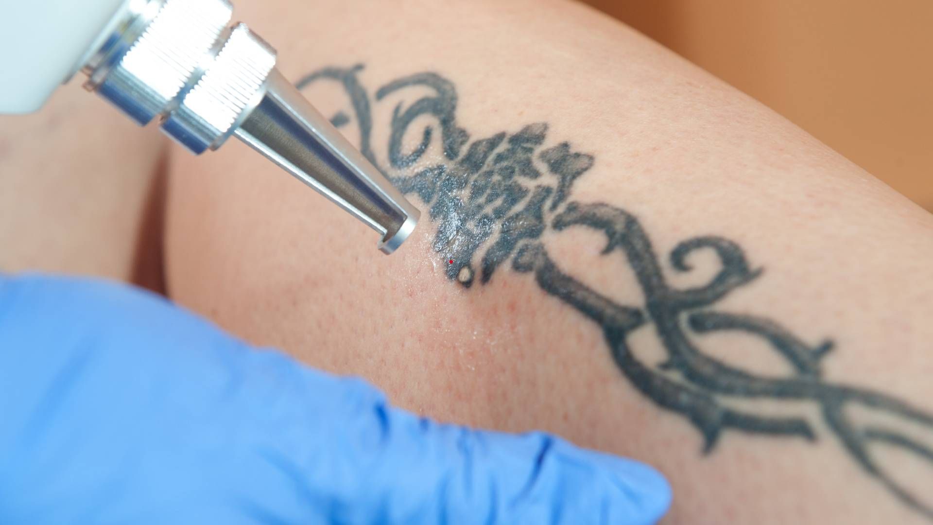 A laser tattoo removal sessions near Lexington, Kentucky (KY)