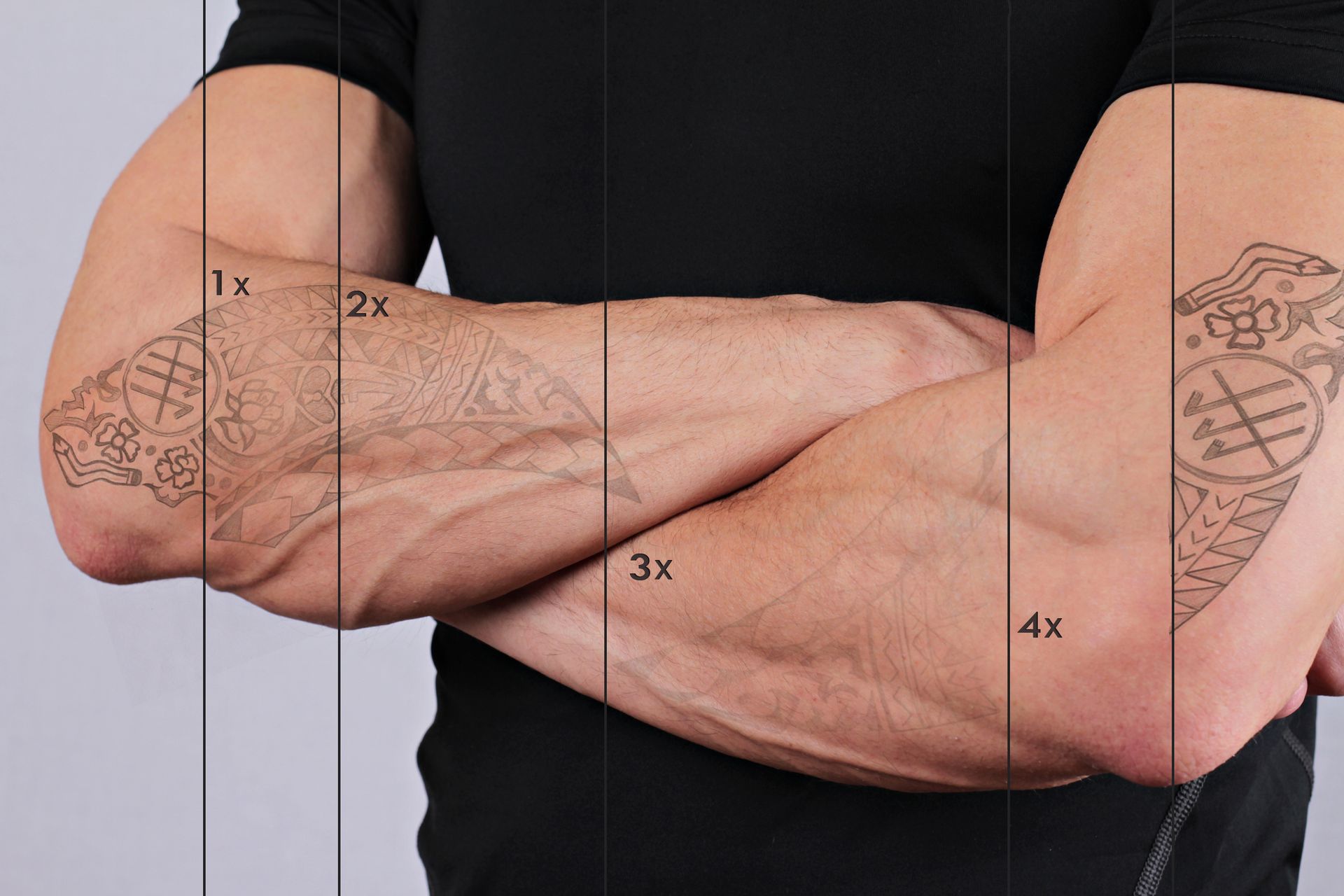 A timelapse graphic showing how laser tattoo removal works over multiple sessions