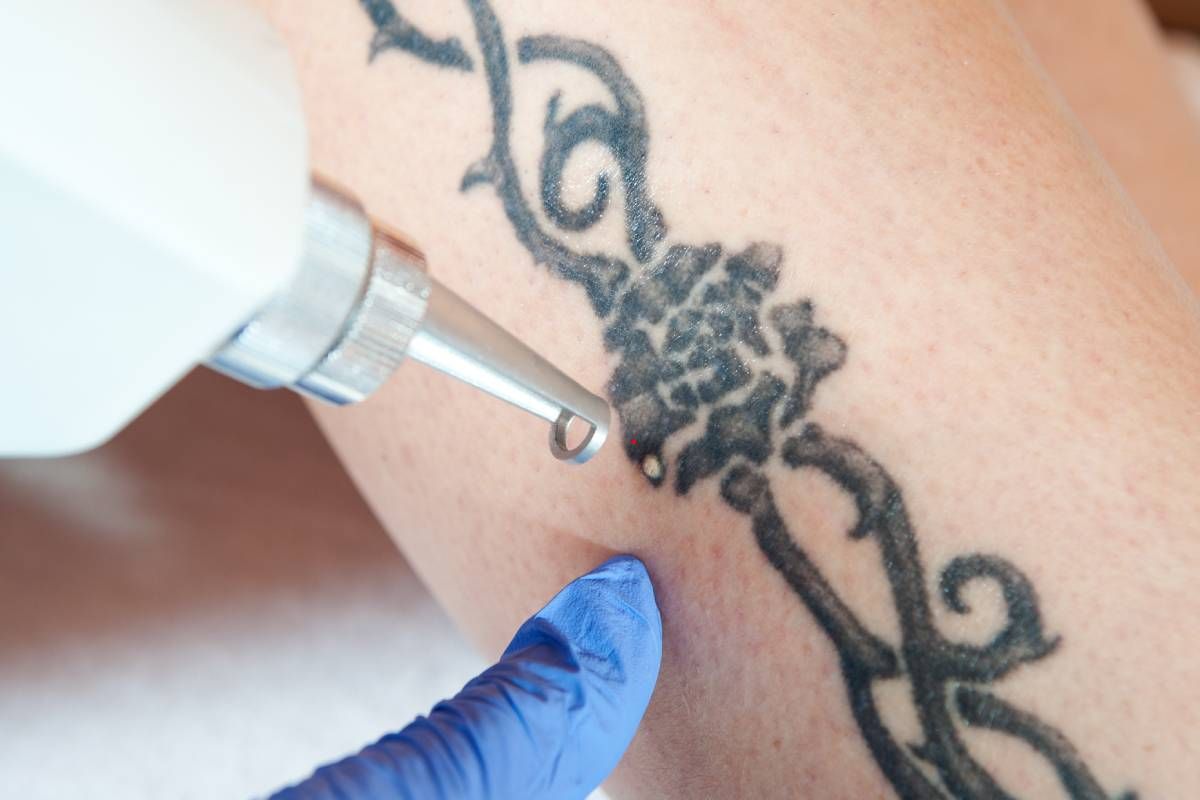 Someone receiving a laser tattoo removal treatment at Lexington Tattoo Removal near Lexington, KY