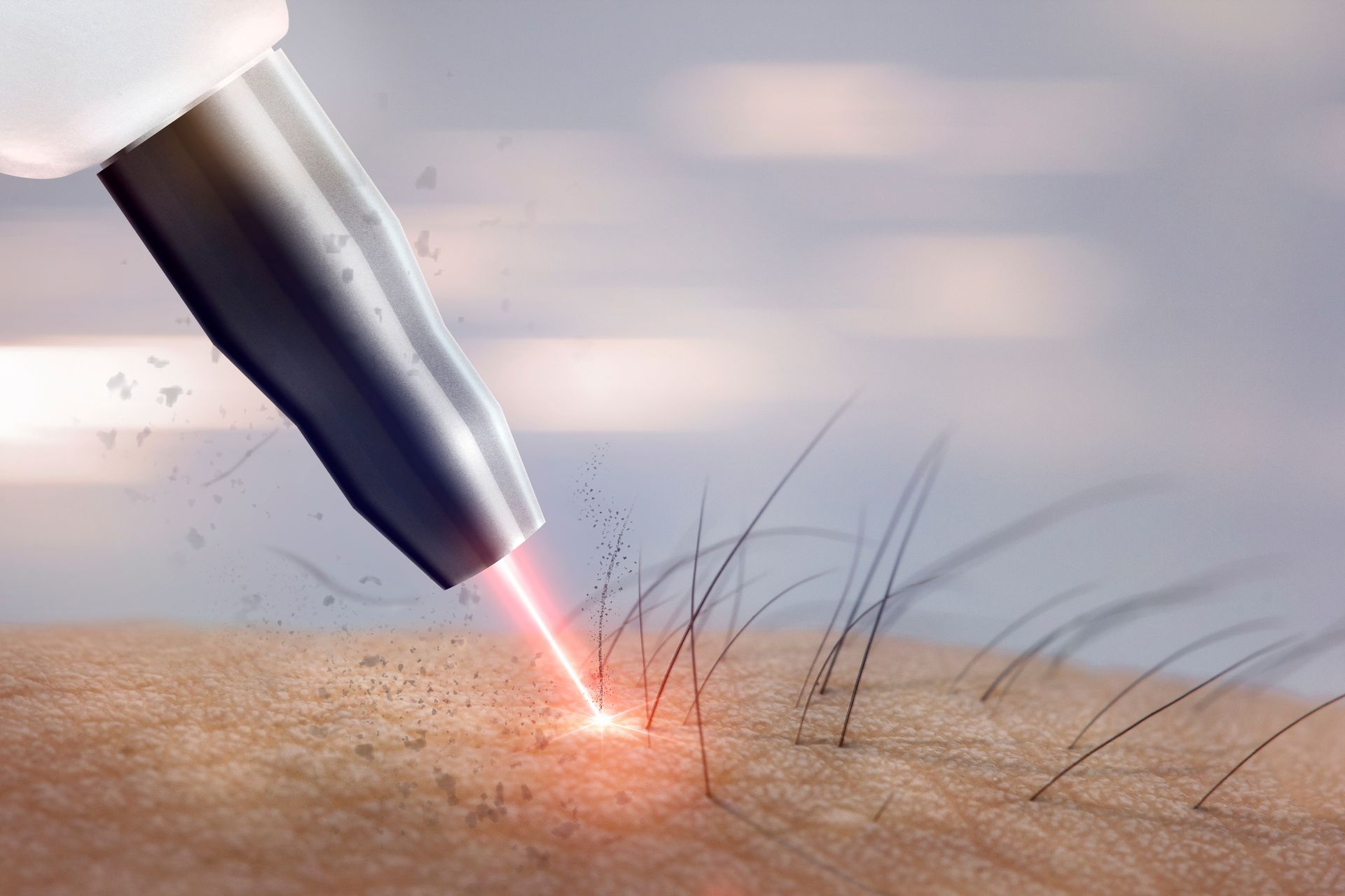 Concept art of a laser hair removal procedure