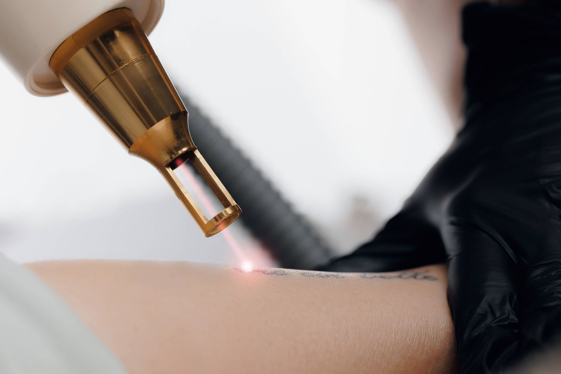 Closeup of a laser tattoo removal from someone's arm