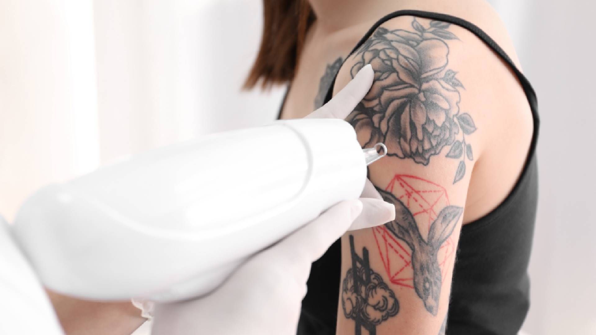 Laser Tattoo Removal: Safe Treatment, Precision Results | Ink Anxiety