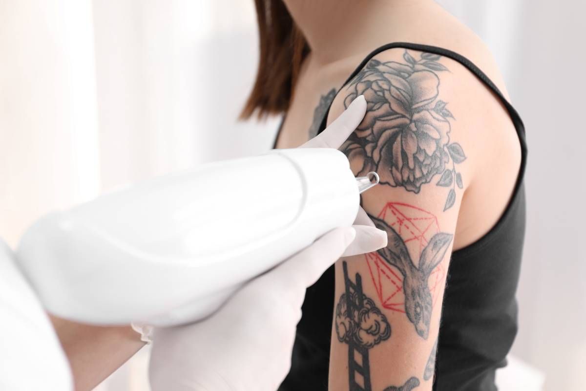 A laser tattoo specialist removing shaky lines from a tattoo in Lexington, Kentucky (KY)