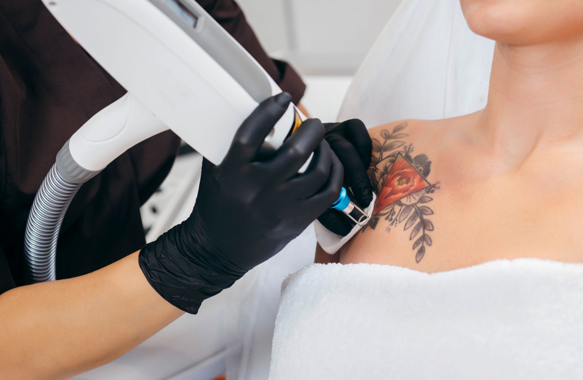 Laser tattoo removal being performed on a woman’s shoulder.