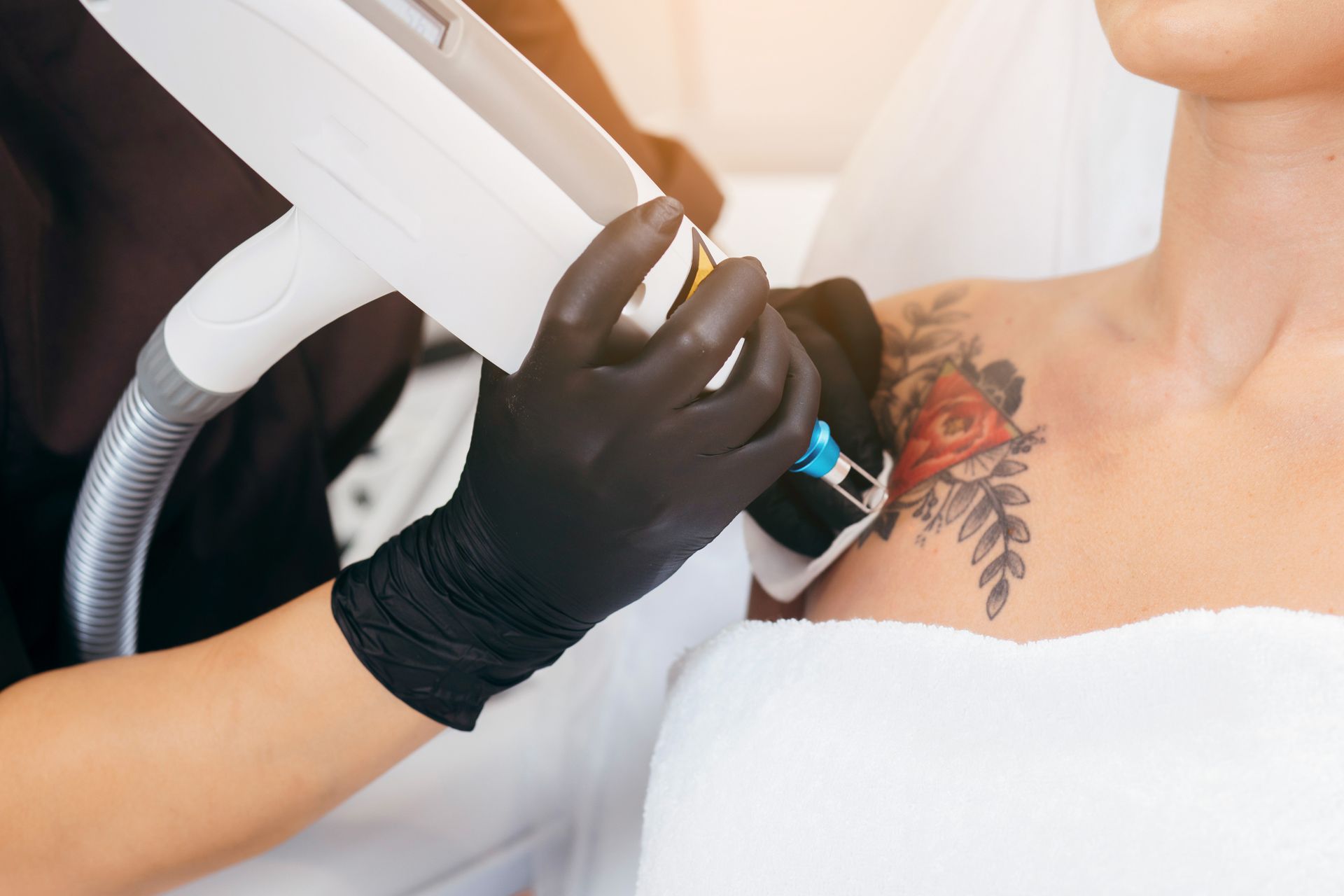 Laser tattoo removal from shoulder 