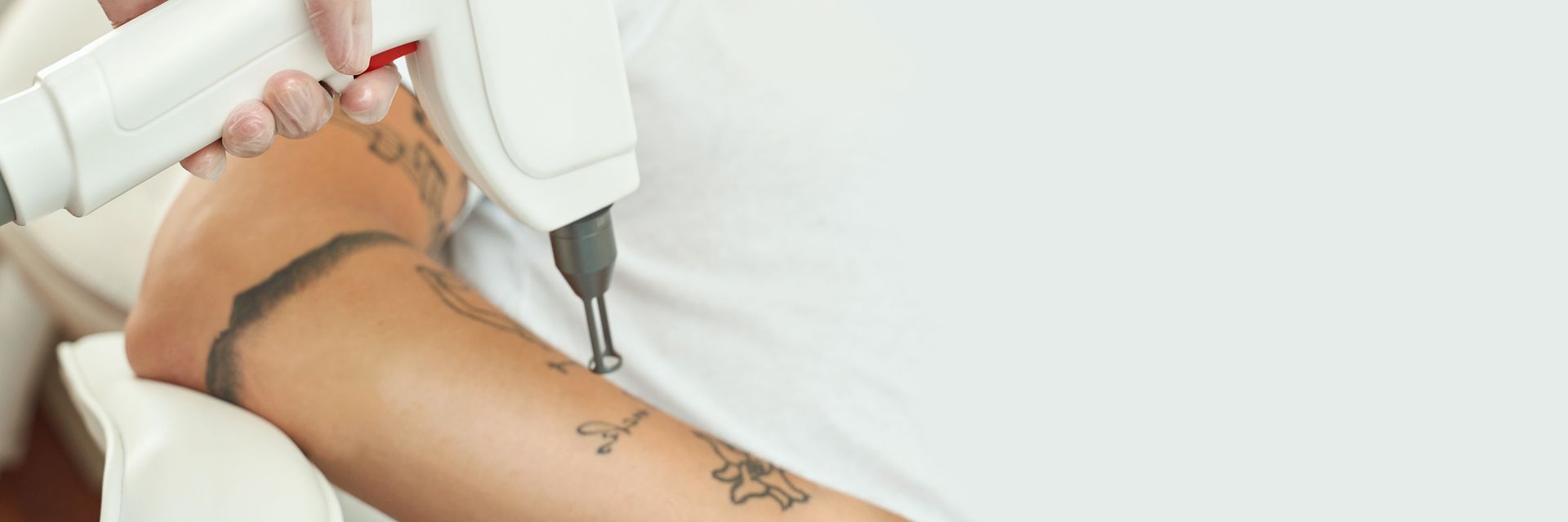 Laser tattoo removal on a lower leg