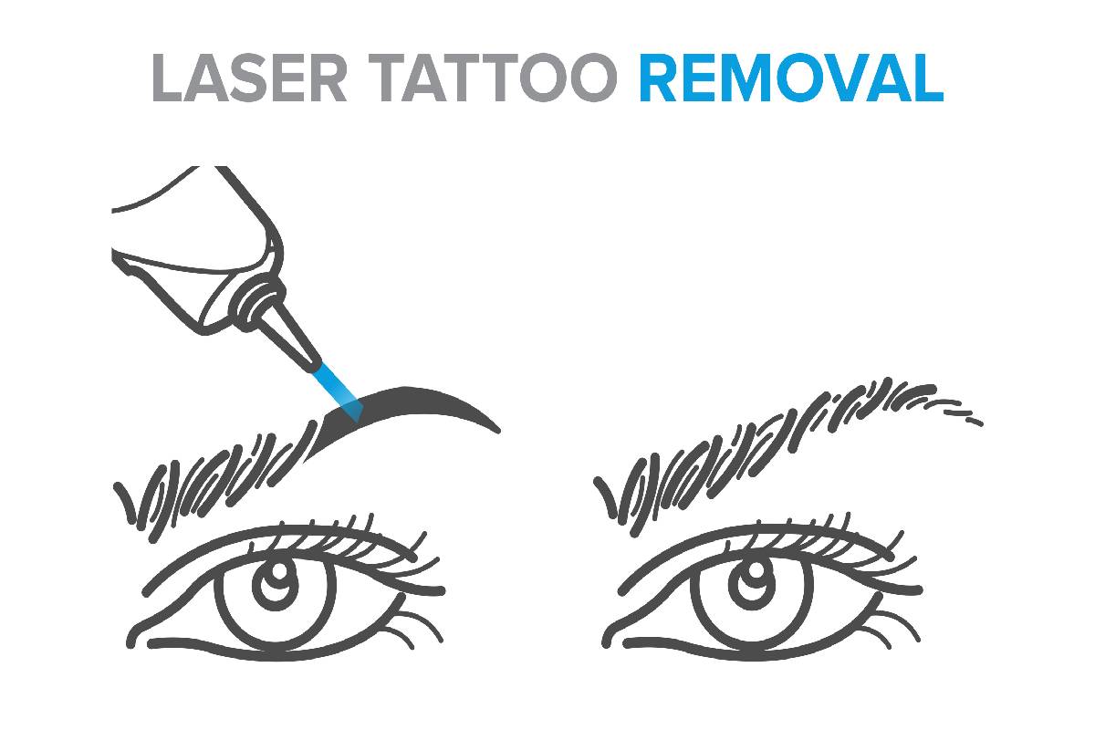 Microblading Removal, Eyebrow Tattoo Removal, Laser Removal Microblading, Microbladed Eyebrow Removal, near Lexington, Kentucky (KY)