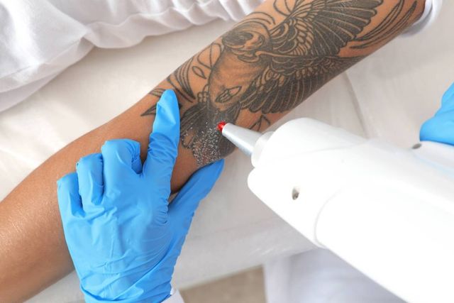 Laser Tattoo Removal | Derma Revive Skin Clinic