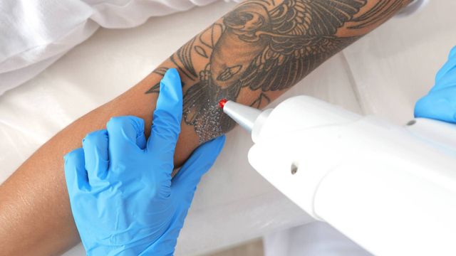 LASER TATTOO REMOVAL⚡ Laser Tattoo Removal is a safe and effective path to  a fresh canvas! With our state of the art lasers and expert… | Instagram