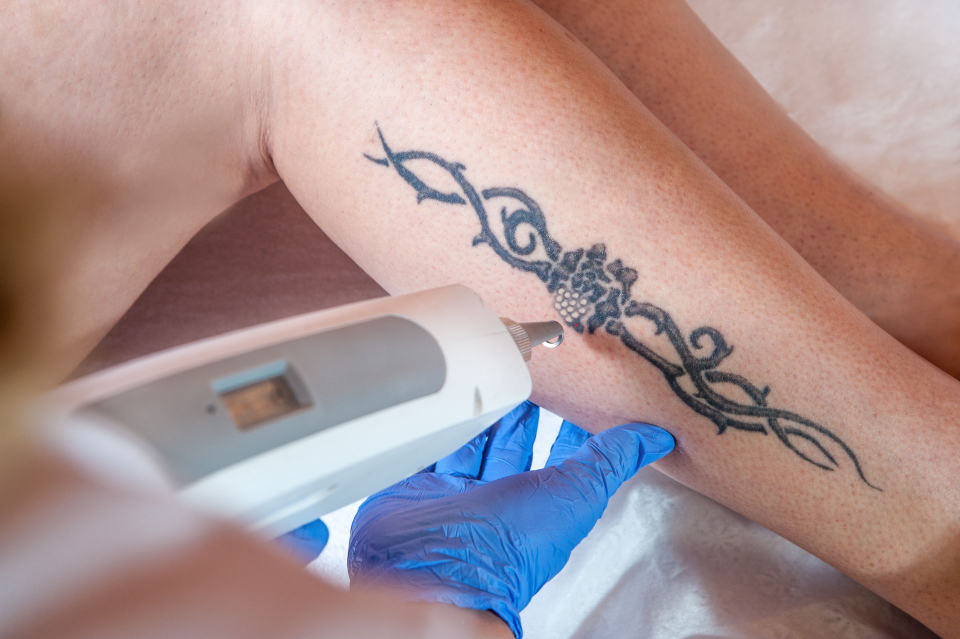 Someone receiving laser tattoo removal on the sensitive part of their leg