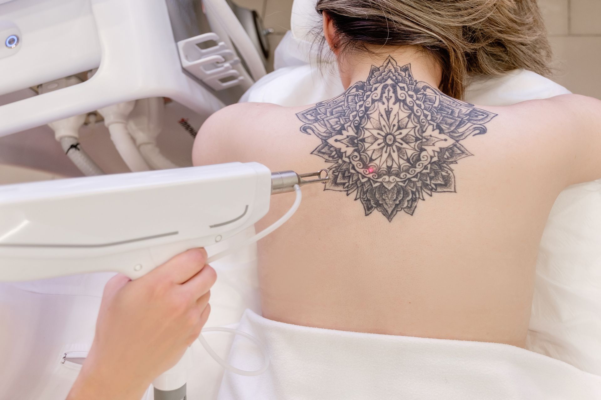 Someone removing an unwanted tattoo from their back with a laser tattoo removal session 