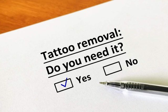 Best Tattoo Removal Lexington KY Cost  Laser Tattoo Removal