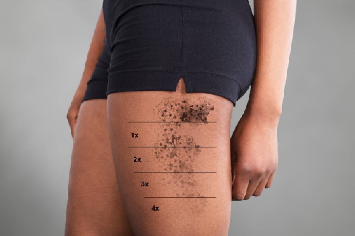 An edited image of a patient after each laser tattoo removal appointment near Lexington, Kentucky (KY)