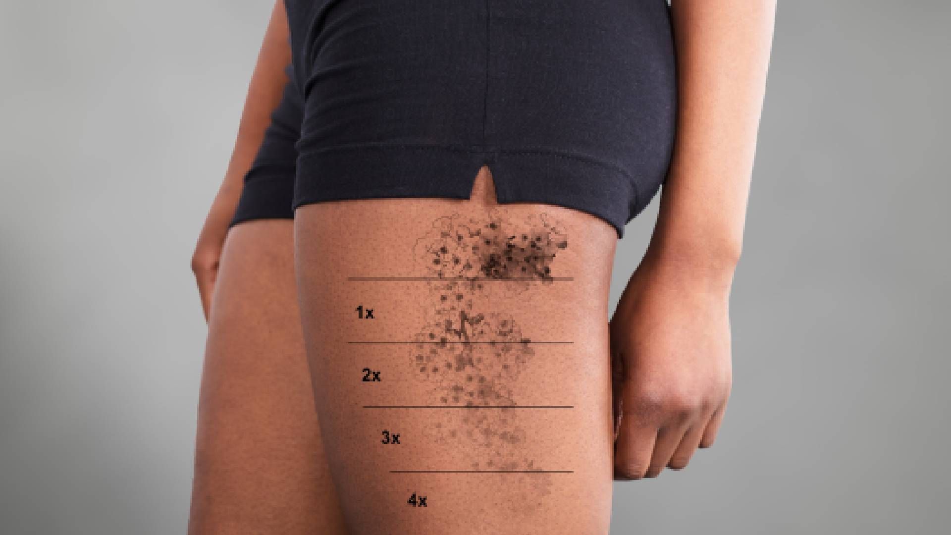 An edited image of a patient after each laser tattoo removal appointment near Lexington, Kentucky