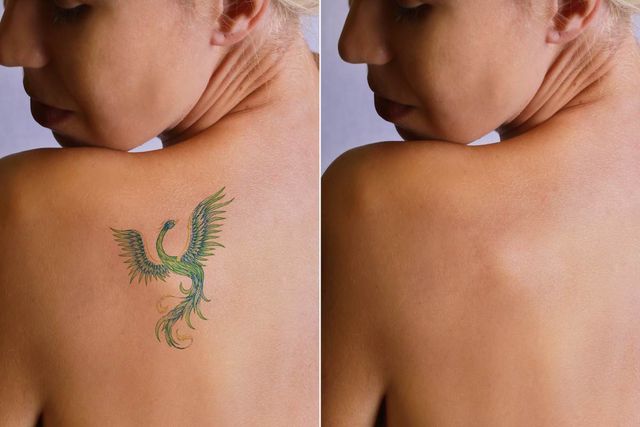 Tattoo Removal  Lexington KY Jazzi Cosmetic Surgery  Aesthetic  Medicine Cosmetic Surgery