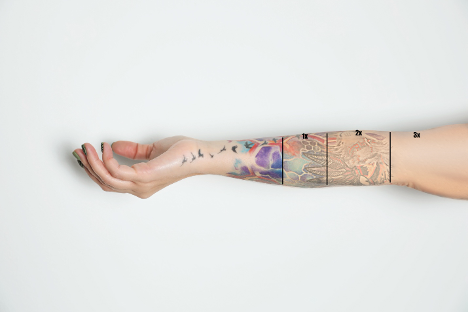 Type II skin before and after laser tattoo removal procedures.
