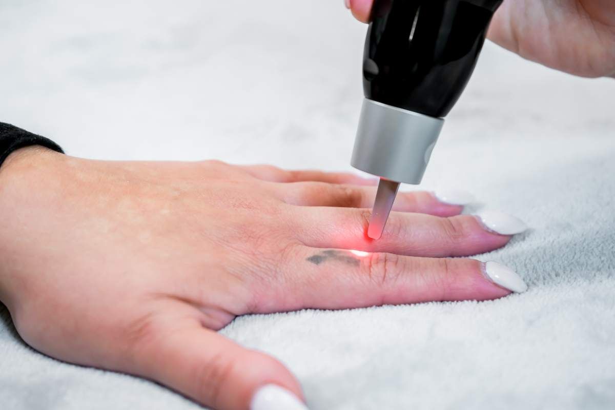 A man receiving tattoo removal services near Lexington, Kentucky (KY)