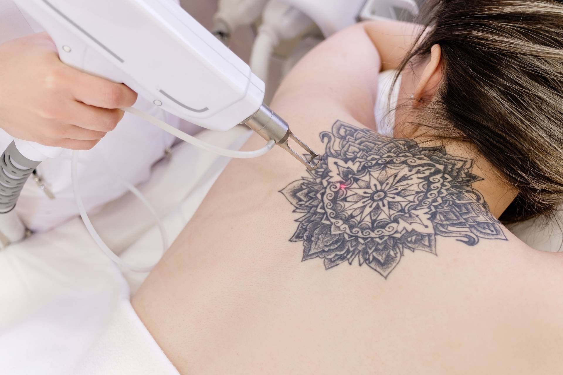 Someone getting laser tattoo removal for a tattoo on their back at Lexington Tattoo Removal near Lexington, Kentucky (KY)