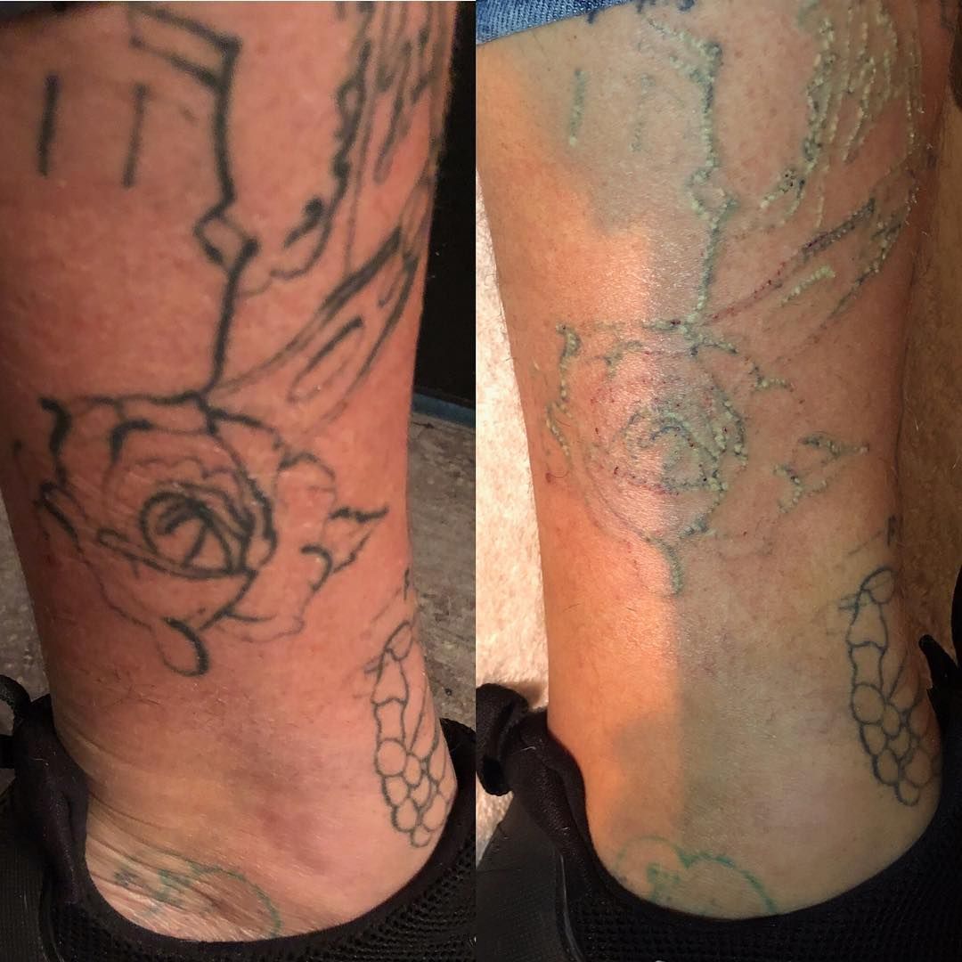 A Person Has a Tattoo of a Rose on Their Leg — Aqua Marine Skin and Beauty in Tuncurry, NSW