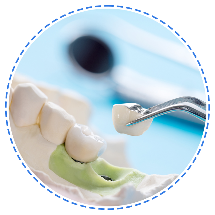 Close Up Implant and Prosthodontic Model — Launceston, TAS — Everything Dental Pty Ltd