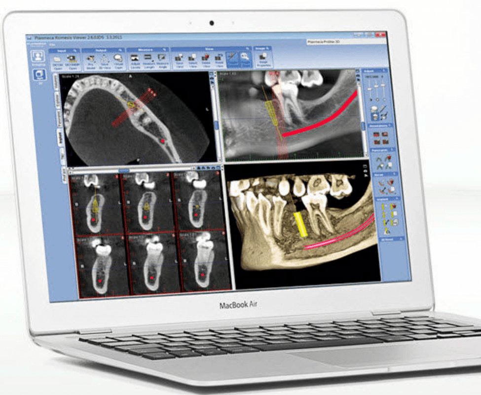 TOMOGRAFÍA CONE BEAM 3D
