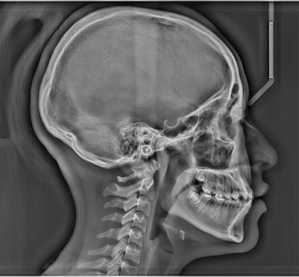 RX TELERADIOGRAFÍA DE PERFIL