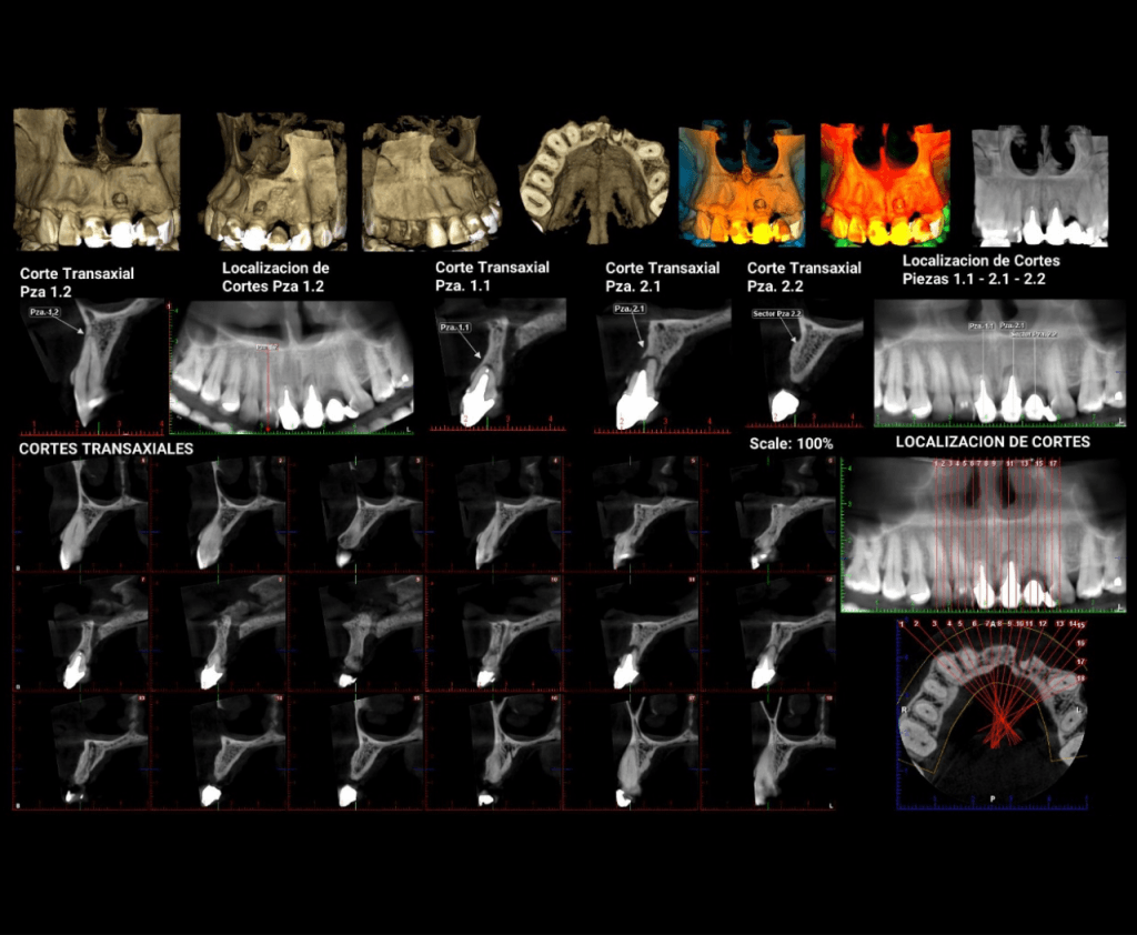 CORTES TOMOGRÁFICOS