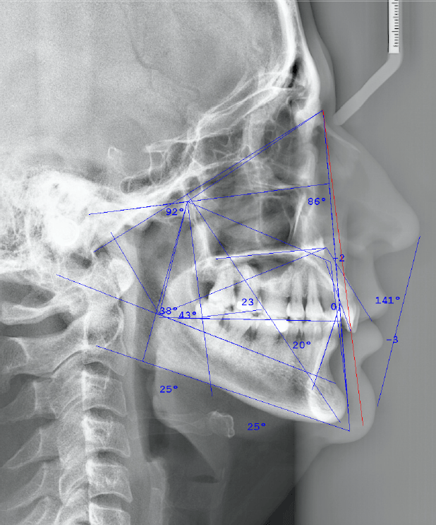 TRAZADOS CEFALOMÉTRICOS