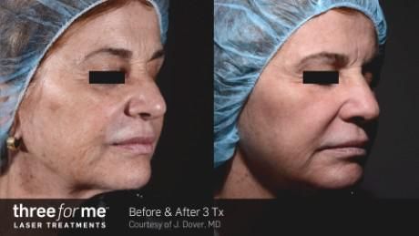 Before and after comparison of facial skin showing reduced sun damage and improved texture following three laser sessions.