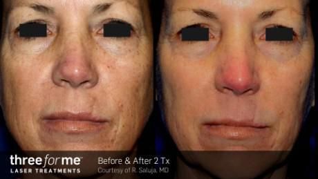 Before and after comparison of facial skin after two laser treatments, showing a reduction in pigmentation and redness.