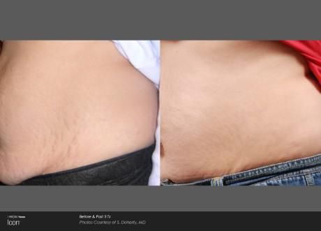 Before-and-after comparison of a person's abdomen, showing skin tightening and reduction of stretch marks.