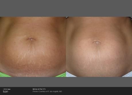 Before and after comparison showing reduced appearance of stretch marks on a lower abdomen.