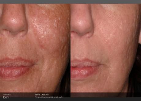 Before-and-after comparison showing reduced skin pigmentation and improved texture on the cheek area after treatment.