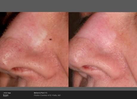 Before and after photos showing a localized patch of skin depigmentation on the side of the nose being treated.