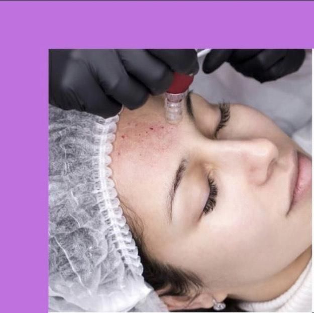 A professional using a microneedling device on a person's forehead during a skincare treatment.