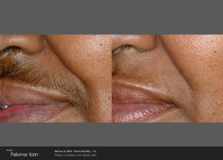 Before-and-after comparison showing the removal of upper lip hair using Palomar Icon laser technology.