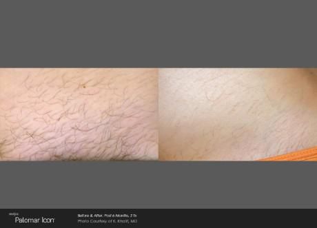 Before and after comparison of skin showing a significant reduction in hair growth following laser hair removal treatment.