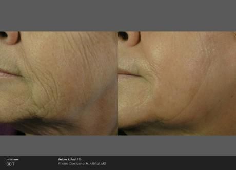 Before and after photos showing reduced facial wrinkles and improved skin texture after a cosmetic treatment.